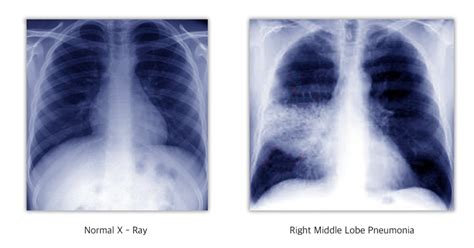 Pneumonia Symptoms Causes Treatment And Prevention