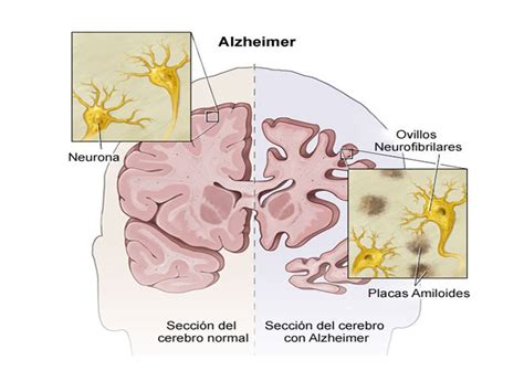 Enfermedad De Alzheimer