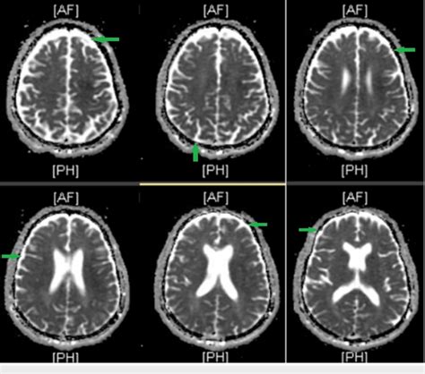 T2-weighted brain MRI of a 70-year-old male with neurosyphilis showing... | Download Scientific ...