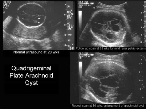 Ultrasound Of Supratentorial Arachnoid Cysts