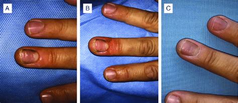 A) Chronic paronychia. The patient had been prescribed several oral and ...