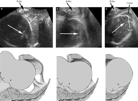 Diagnosis Of Station And Rotation Of The Fetal Head In The Second Stage 91590 Hot Sex Picture