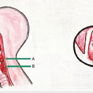 Mccaffrey Classification Of Development Of Subglottic Stenosis Green