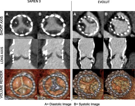 Clinical Impact Of Hypoattenuating Leaflet Thickening After