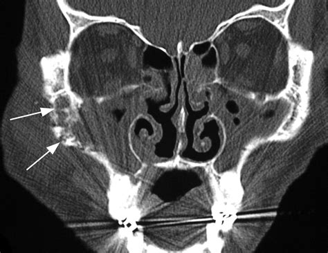 Imaging Features Of Invasive And Noninvasive Fungal Sinusitis A Review