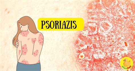 Psoriazisul La Copii Simptome Tratamente Si Sfaturi Pentru