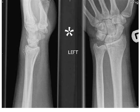 A Fracture Of The Tip Of The Ulnar Styloid With A Stable Dru Joint