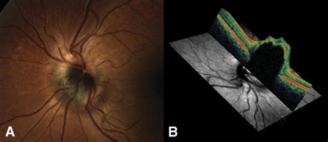 Optical Coherence Tomography Pathology Correlation Of Optic Disc Melanocytoma Ophthalmology