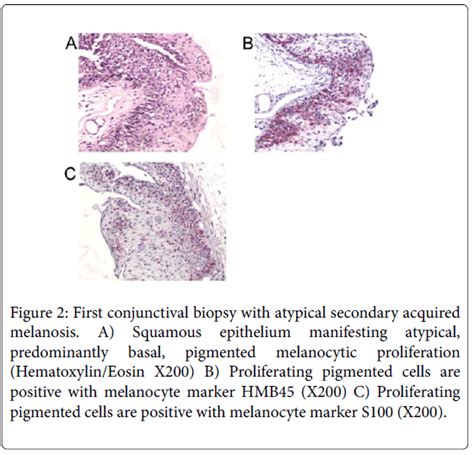 Conjunctival Cyst Histology