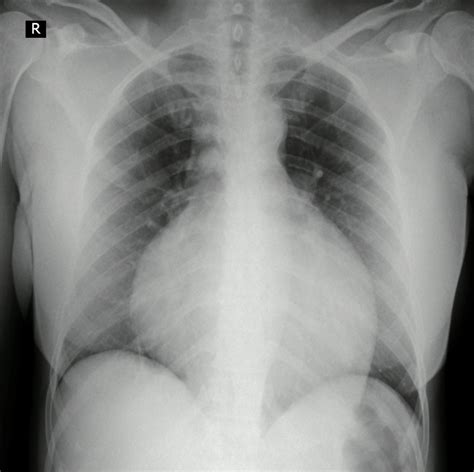 Chest X Ray Global Cardiomegaly With Enlarging Cardiothoracic Ratio Download Scientific