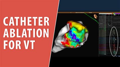 Catheter Ablation For Ventricular Tachycardia