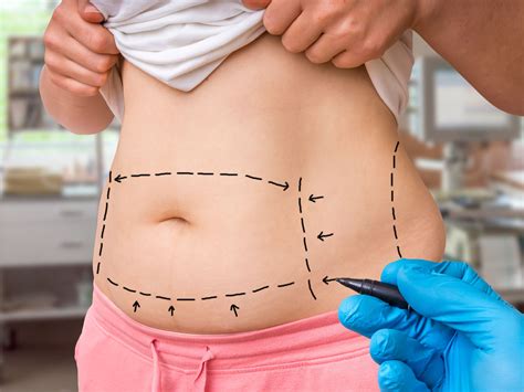 Gaining Weight After Abdominal Liposuction Blog Dandk