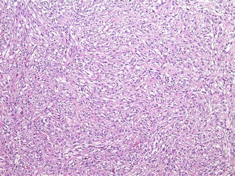 Clear Cell Sarcoma | Radiology Key