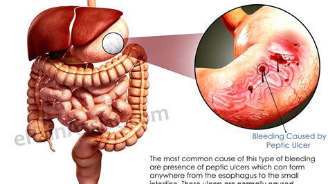 Symptoms Of Colon Ulcers Ulcer Choices