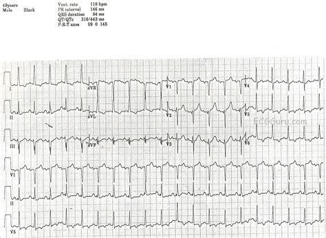 Inverted T waves in Lateral Wall | ECG Guru - Instructor Resources