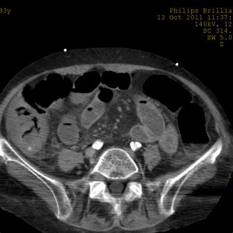 Axial Ct Image At Arterial Phase Demonstrates A Thickened Caecal Wall