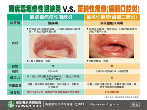 腸病毒泡疹性咽峽炎vs單純性泡疹比較圖片－宜蘭縣冬山鄉廣興國小 健康中心部落格｜痞客邦