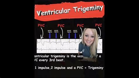 Ventricular Trigeminy || EMS Cardiology - YouTube