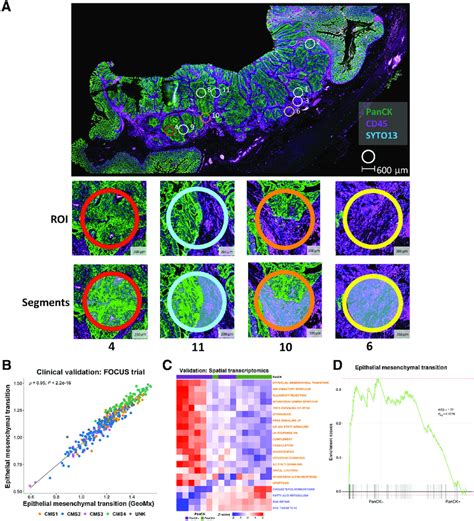 Spatial Transcriptomic Confirms The Confounding Effects Of The Stroma