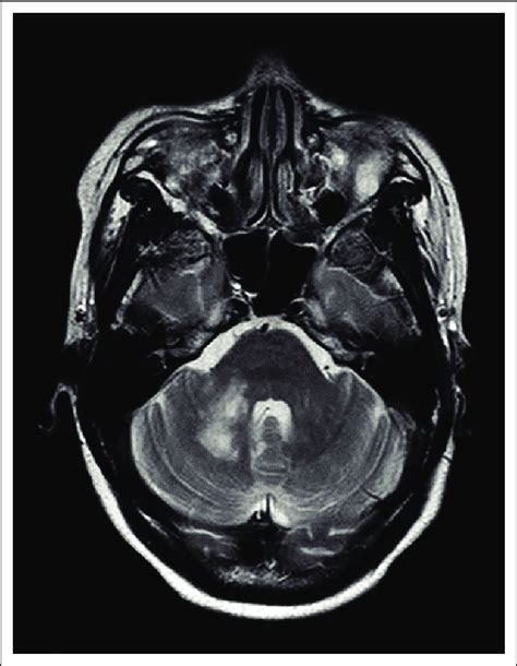 Axial T2 Weighted Image Of The Patient In Case 6 Showing High Signal Download Scientific