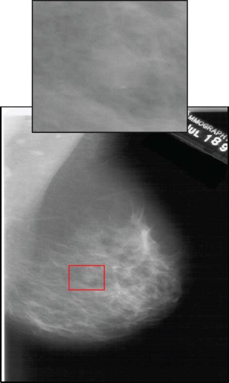 Mammogram samples of the four BI-RADS categories taken from the DDSM... | Download Scientific ...