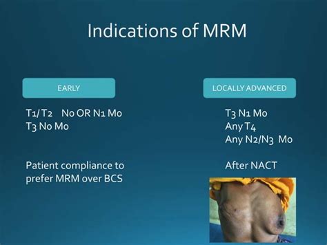 Modified Radical Mastectomy