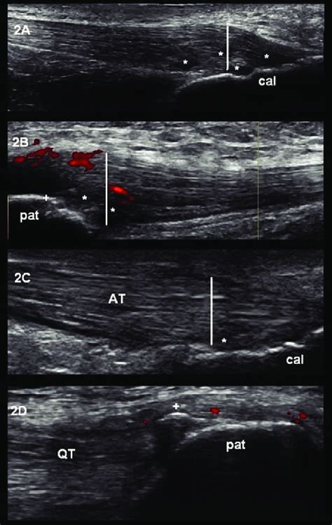 In Patients With Psoriatic Arthritis There Is Evidence Of Enthesopathy