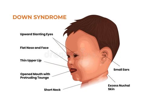 Caracter Sticas Faciais Do Beb S Ndrome De Down Sintomas De