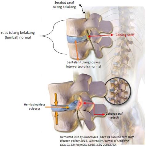 Penyebab Hnp Herniasi Nukleus Pulposus Pengobatan Sesuai Medis