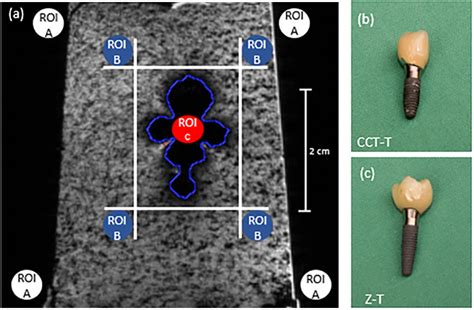 Protocol For The Evaluation Of Mri Artifacts Caused By Metal Implants