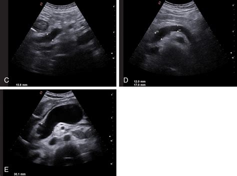 The Role Of Ultrasound In Portal Hypertension Radiology Key