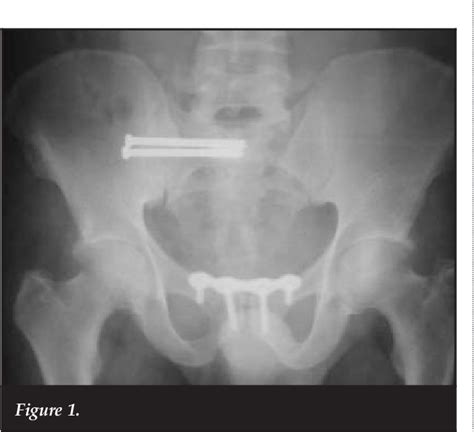 Figure 1 From The Safety And Efficacy Of Percutaneous Sacroiliac Joint