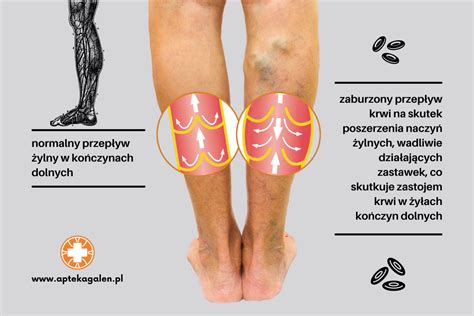 Żylaki i przewlekła niewydolność żylna objawy leczenie przyczyny