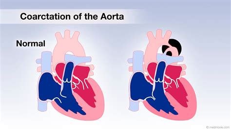 Patent Ductus Arteriosus Animation