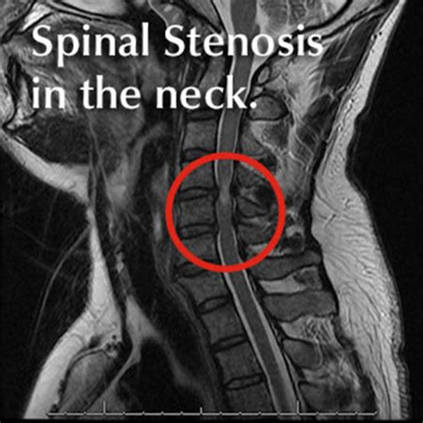 Myelopathy Treatment in Dallas, Texas | DISC Spine Institute