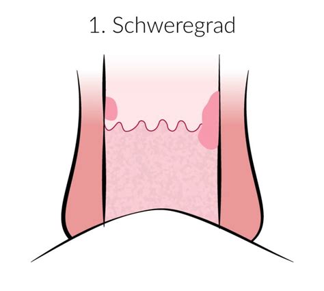 Hämorrhoiden Symptome erkennen Grade Verlauf kanyo