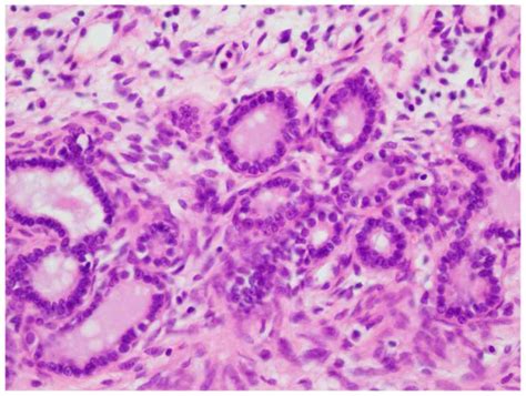 Bilateral And Multiple Mixed Epithelial And Stromal Tumors Of The