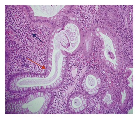 Histopathology Of Descending Colon Biopsy Showing Uc Picture Download Scientific Diagram