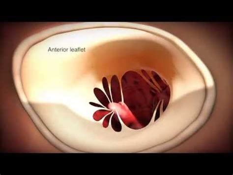 Minimally Invasive Robotic Mitral Valve Repair Animation YouTube