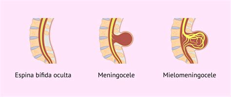 Espina Bífida Guía Completa Clínica Uner