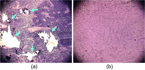 Histology Photographs Of Retinoblastoma And Uveal Melanoma A