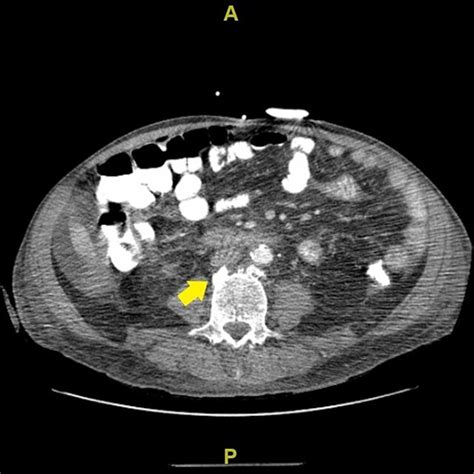 Computerized Tomography Scan Of Abdomen And Pelvis Sclerotic Lesions