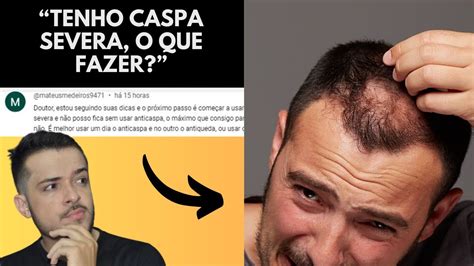 Como Tratar A Caspa Severa Queda De Cabelo E Calv Cie Masculina Youtube