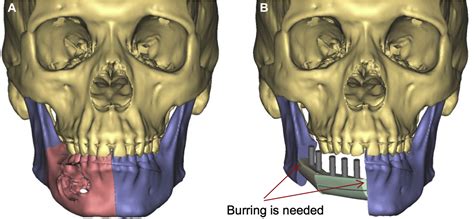 Fibula Jaw In A Day State Of The Art In Maxillofacial Reconstruction