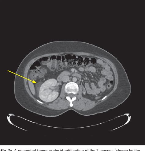 Figure 1 From A Case Of Pararenal Angiomyolipoma Arising From An