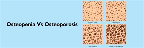 Conhe A A Diferen A Entre Osteopenia Versus Osteoporose E Tratamentos