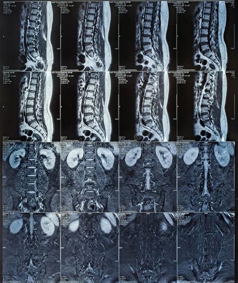 Magnetic Resonance Imaging Or Mri Scan Report Of Spinal Cord Or Lumbar