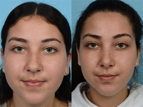 Rhinoplasty Before After Photos Patient 586 Chicago IL TLKM