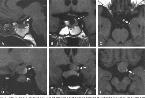 Figure From Correlation Of High Signal Intensity Of The Pituitary