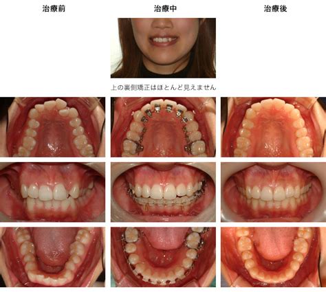 見えない裏側矯正－矯正歯科・名古屋から急行で10分「ひらざわ矯正歯科クリニック愛知」